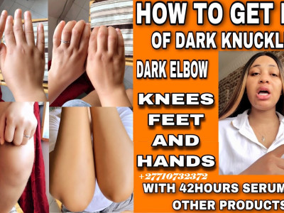 Dark Knuckle Whitening Serum In Howick Call +27710732372